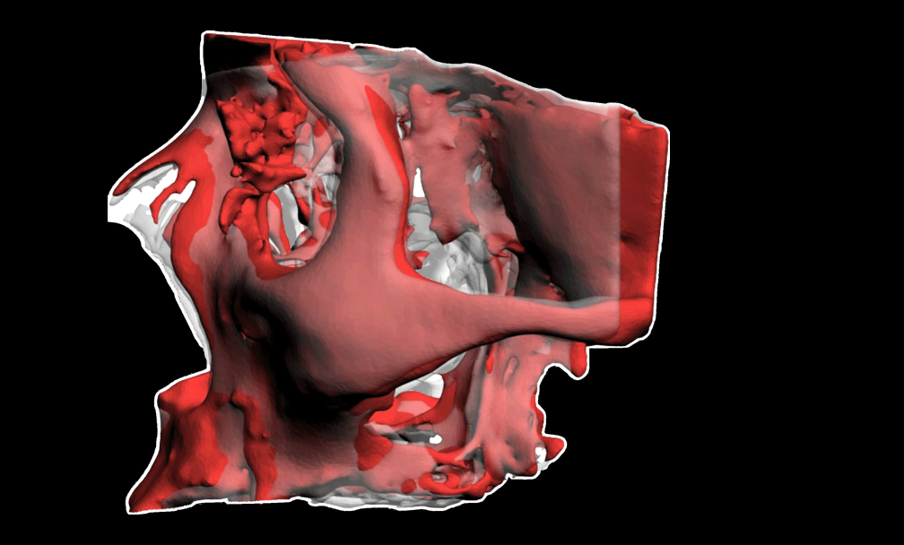 3D reconstruction of the maxillofacial skeleton over a CT scan