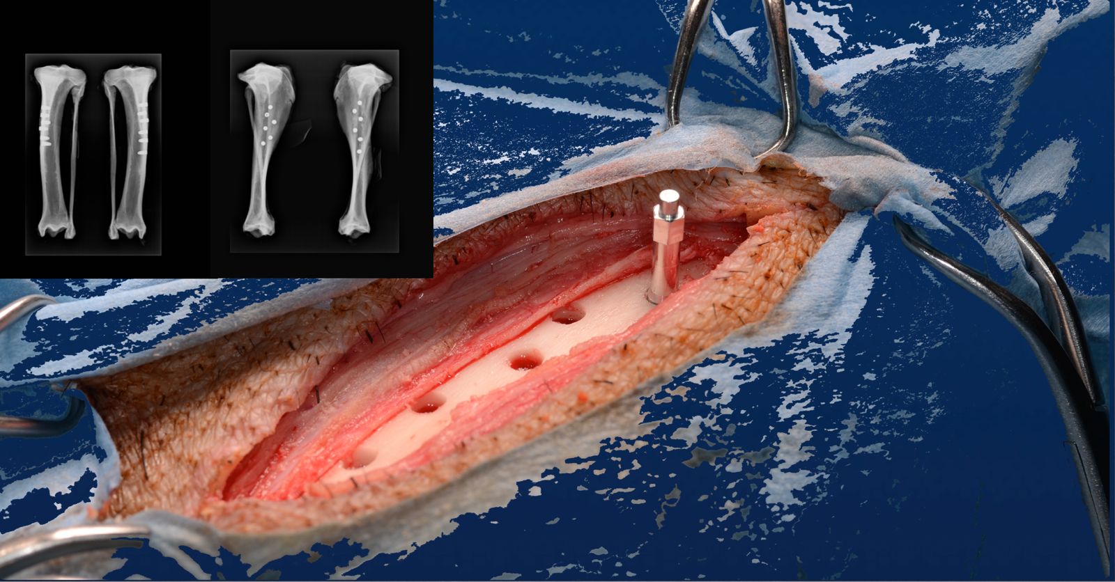 Osteosynthesis — bone fixation with precision instruments
